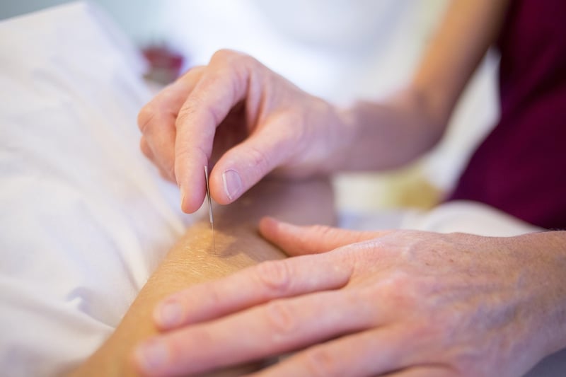 Acupuncture Benefits